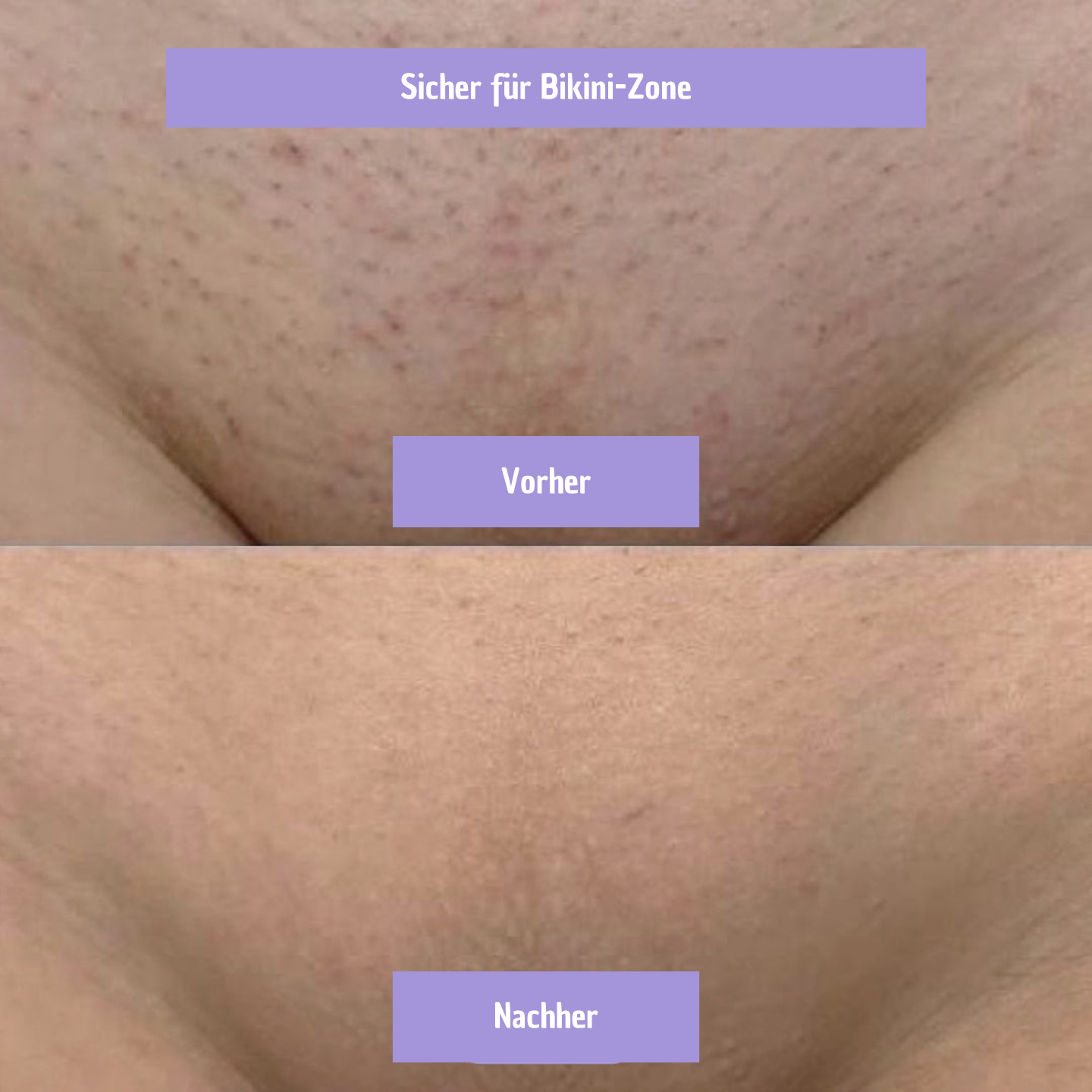 Glaire Haar-Entferner